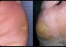 What is the Difference Between a Corn and a Callus on the Foot?